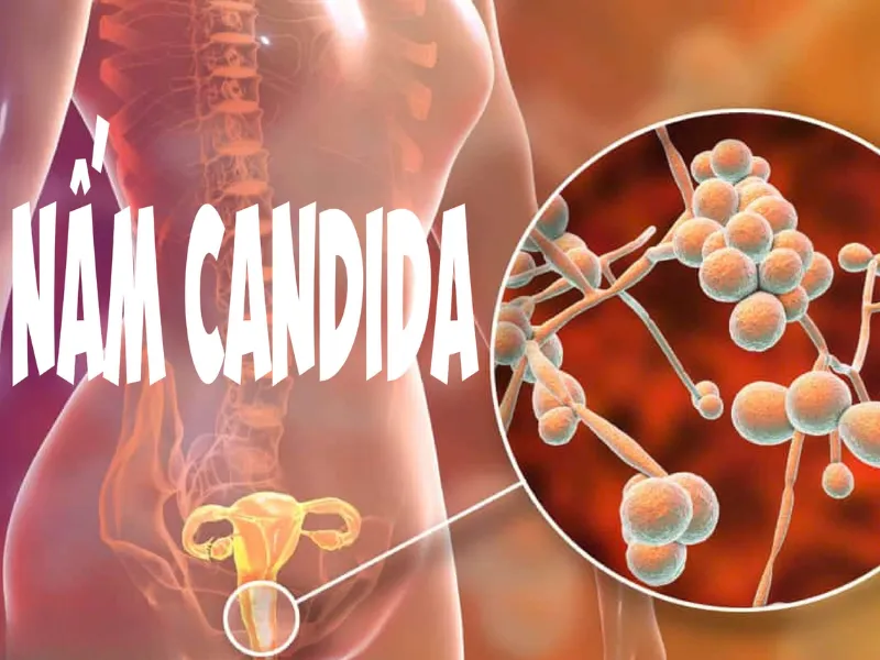 Nhiễm nấm Candida