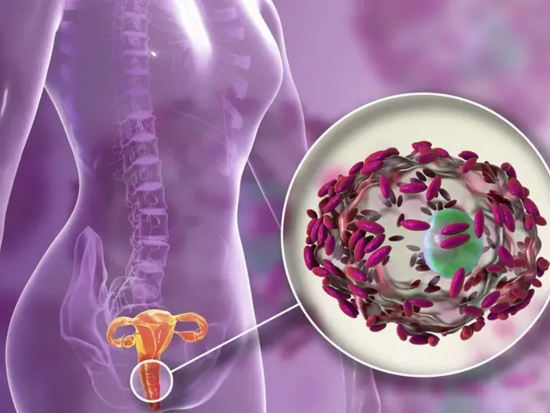 Viêm âm đạo do vi khuẩn (Bacterial Vaginosis – BV)