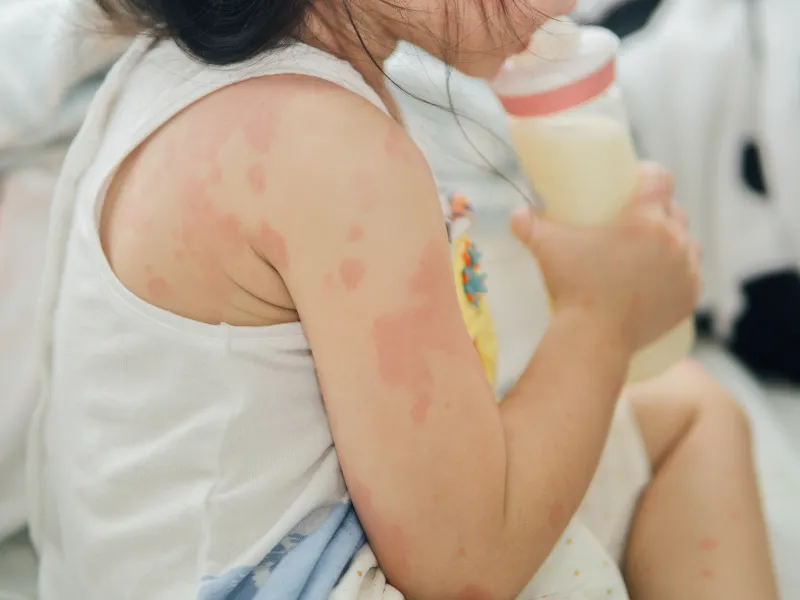 Nhiễm khuẩn ngoài da