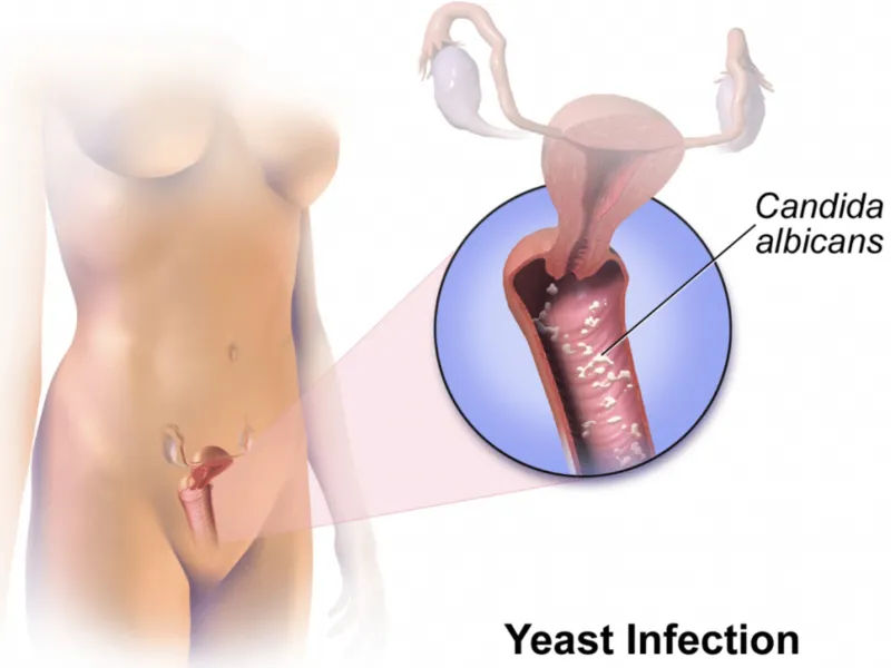 Nhiễm nấm Candida