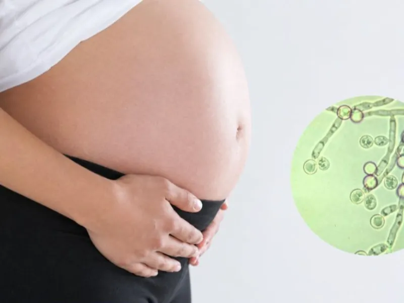 Viêm âm đạo do tạp khuẩn (Bacterial Vaginosis - BV)