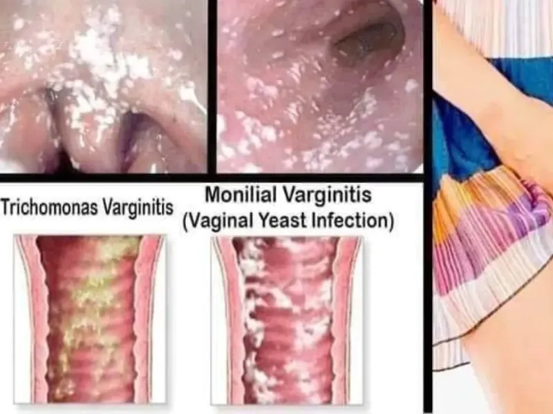 Viêm âm đạo do nấm Candida là loại phổ biến nhất
