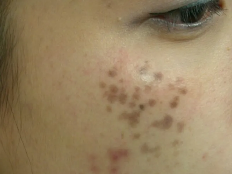 Nám chân sâu (Dermal Melasma)