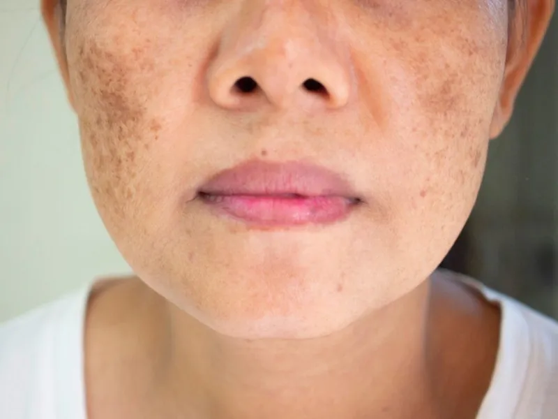 nám hỗn hợp