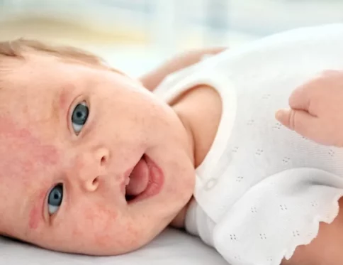 Chàm bội nhiễm ở trẻ em