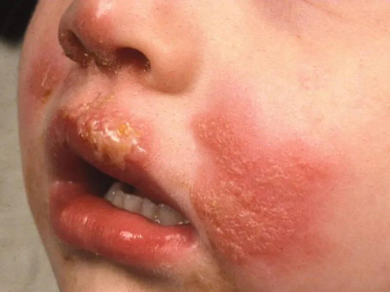 Chàm bội nhiễm ở trẻ em là tình trạng vết chàm bị nhiễm vi khuẩn hoặc virus gây sưng đỏ, mụn mủ, đau rát và sốt.
