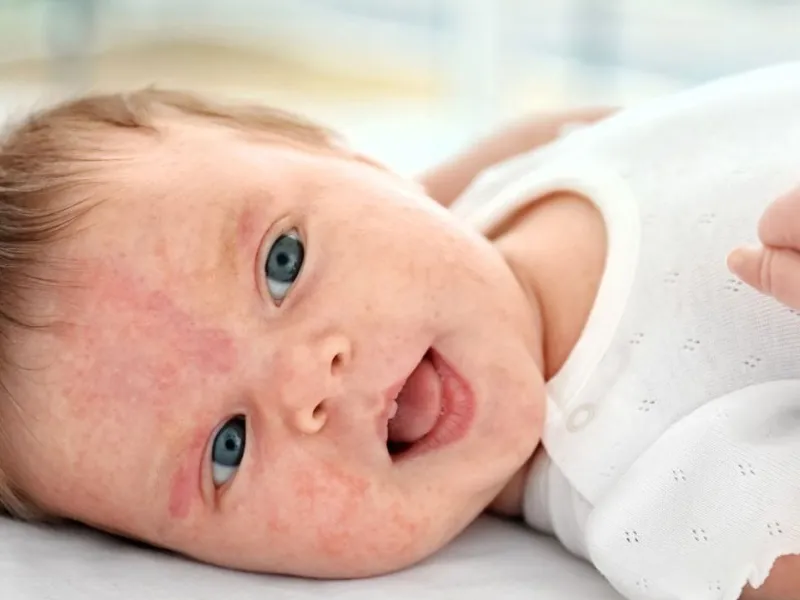 Bệnh chàm bội nhiễm ở trẻ em thường phát triển qua nhiều giai đoạn