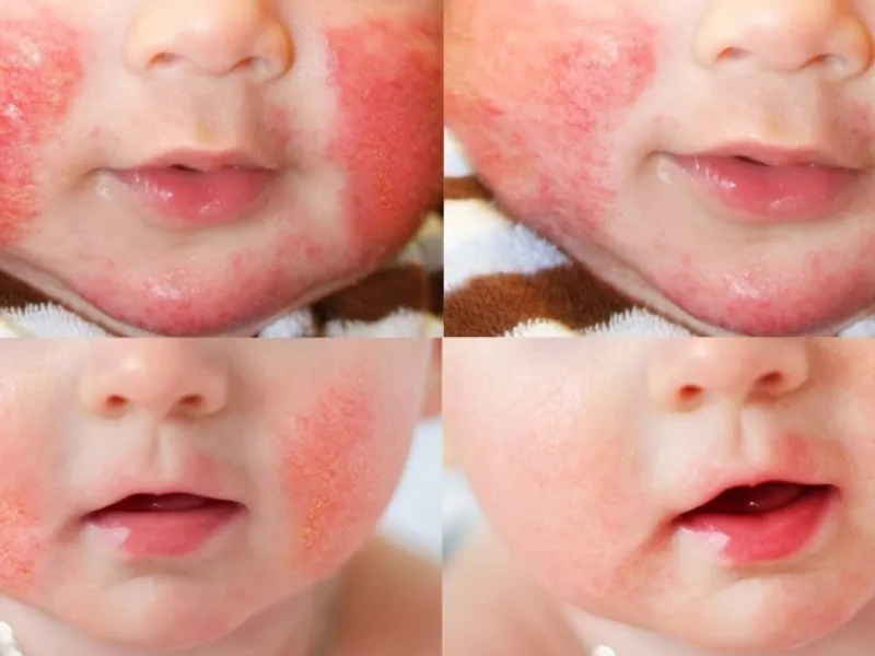 Chàm bội nhiễm ở trẻ em trong giai đoạn đầu da bé sẽ đỏ hơn và lan rộng nhanh