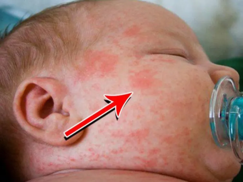 Chàm bội nhiễm có thể gây ra nhiều biến chứng nguy hiểm