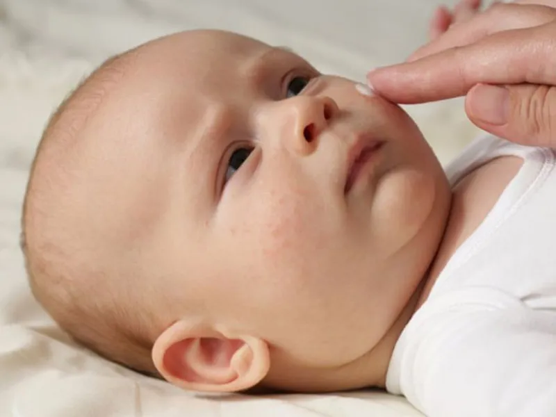 Ba mẹ nên chăm sóc da cho bé theo hướng dẫn của bác sĩ