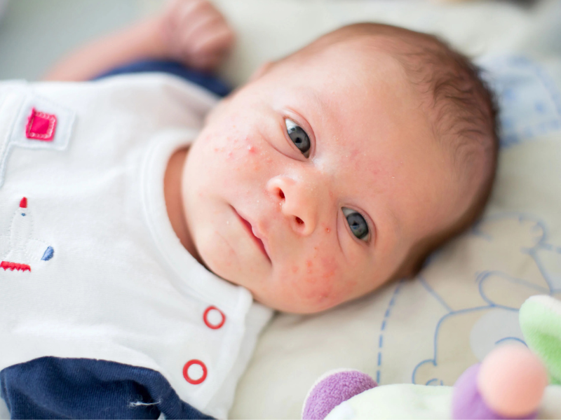 Chàm sữa bao lâu thì hết - Thời gian phục hồi phụ thuộc nhiều vào chế độ chăm sóc của ba mẹ