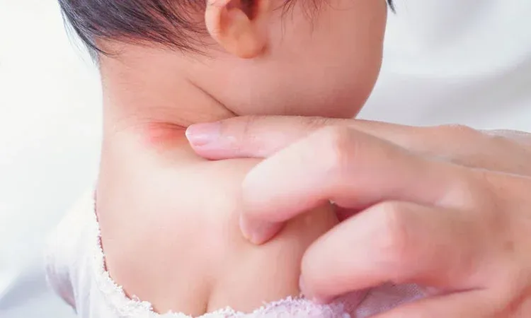 Bé bị chàm sữa ở cổ cần được bôi kem dưỡng ẩm