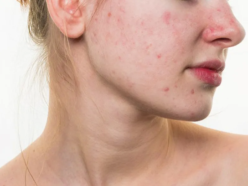 Lạm dụng sửa rửa mặt có thể gây ra những hệ luỵ xấu cho da