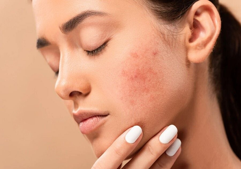 da mặt nhạy cảm dễ nổi mụn
