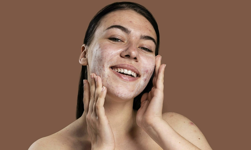 da mặt nhạy cảm dễ nổi mụn