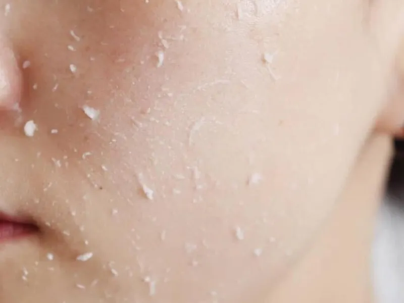 Tích tụ tế bào chết làm da xỉn màu