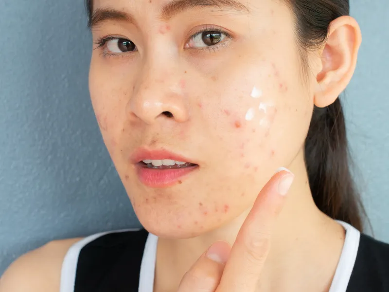 Đến tháng có nên nặn mụn không?