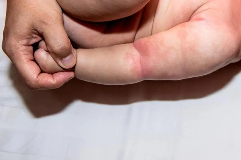 Hình ảnh rôm sảy vùng nếp gấp