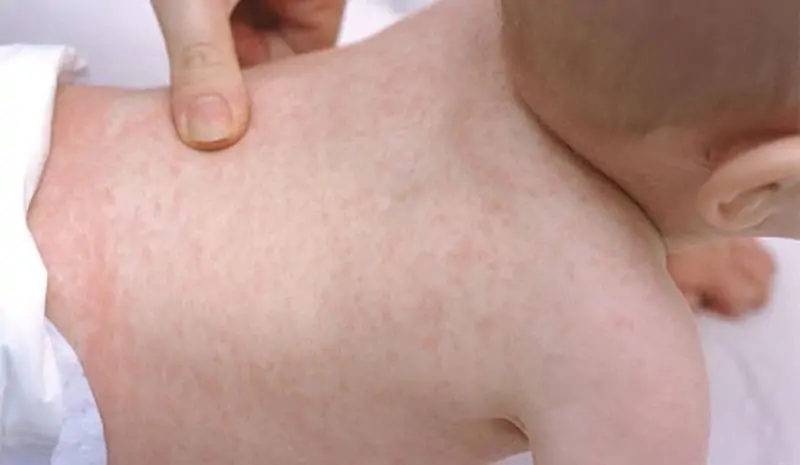 Hình ảnh rôm sảy vùng lưng, ngực, bụng