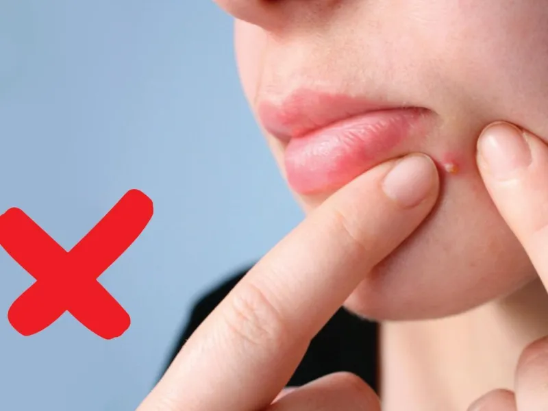 Không tự ý nặn mụn để tránh viêm nhiễm