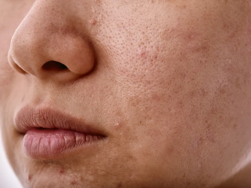 Mẹ bầu da mặt xấu – Nguyên nhân do đâu?