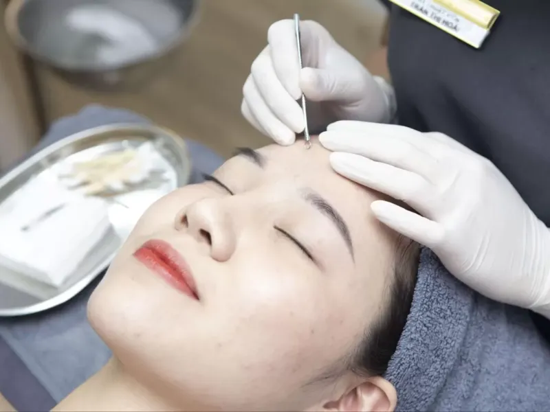 Nặn mụn xong có nên rửa mặt không?