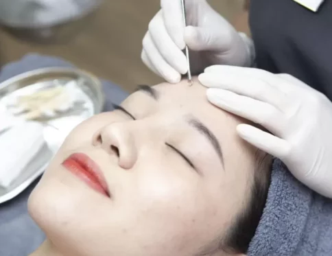 nặn mụn xong có nên rửa mặt không