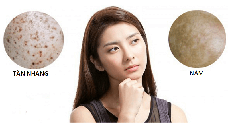 phân biệt nám và tàn nhang