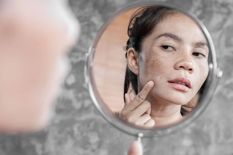 phân biệt nám và tàn nhang