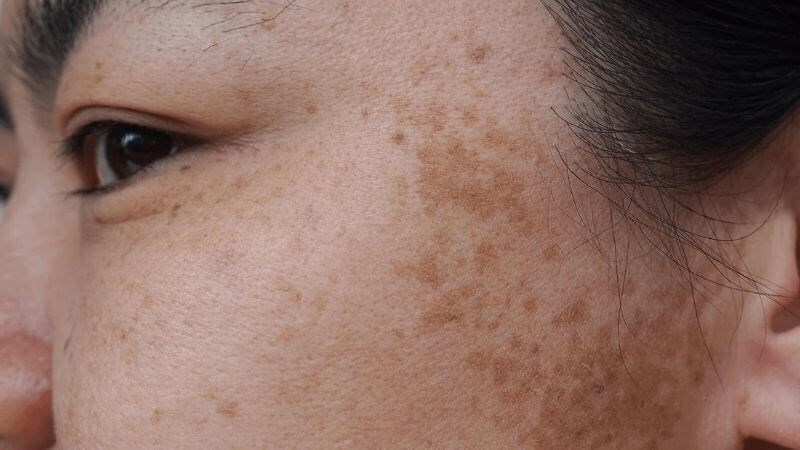 phân biệt nám và tàn nhang
