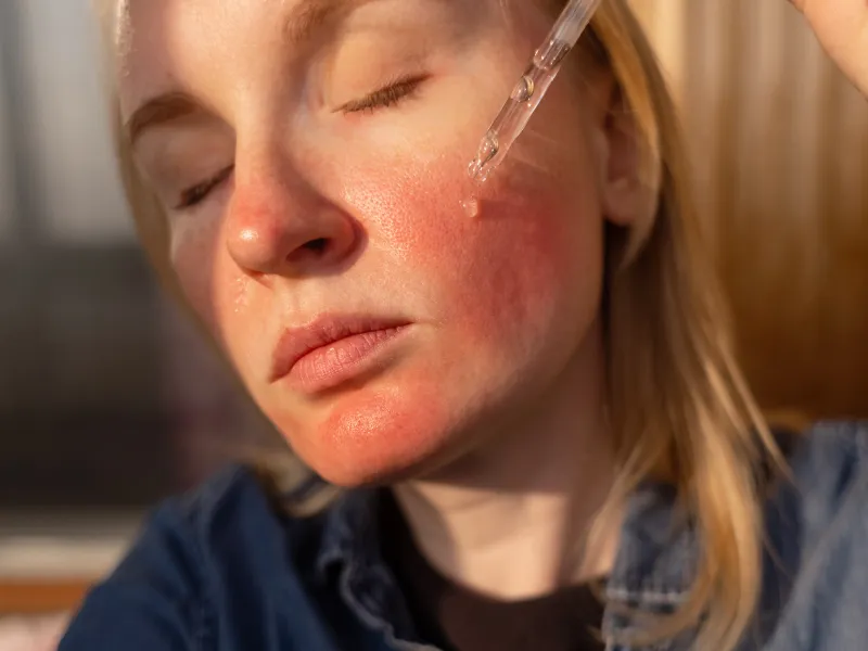Niacinamide (Vitamin B3)