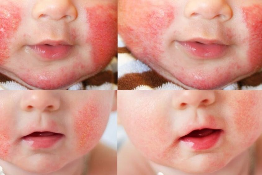 trẻ sơ sinh nổi mẩn đỏ ở mặt