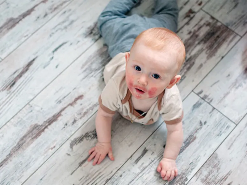 Viêm da dị ứng ở trẻ em và người lớn sẽ có những biểu hiện khác nhau