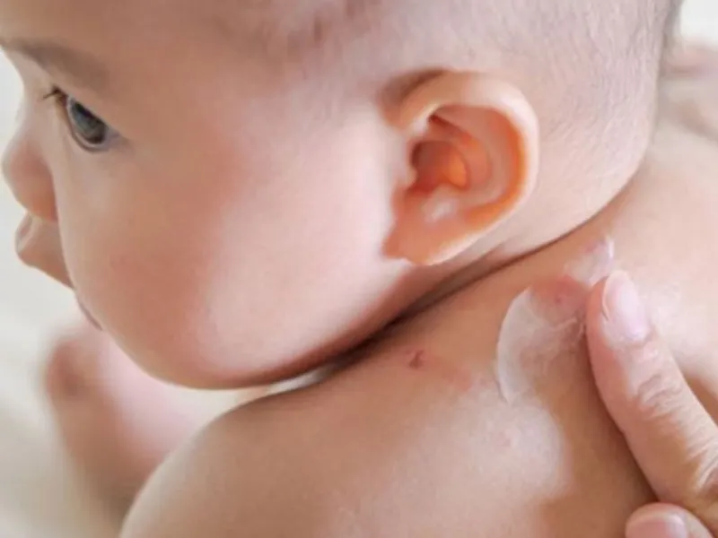 Bôi kem dưỡng da sai cách có thể khiến rôm sảy ngày càng nặng hơn