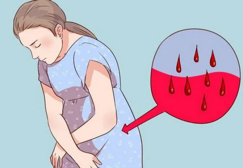 Sản dịch kéo dài tạo môi trường cho vi khuẩn phát triển