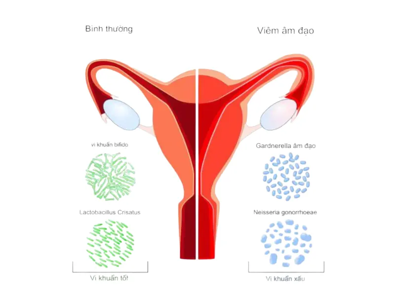 Các bệnh phụ khoa sau sinh thường gặp viêm âm đạo