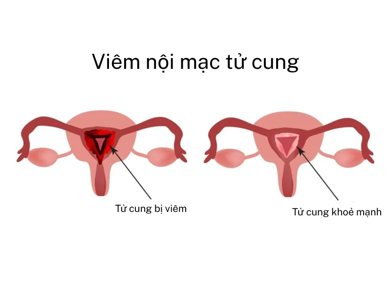 Viêm nội mạc tử cung sau sinh