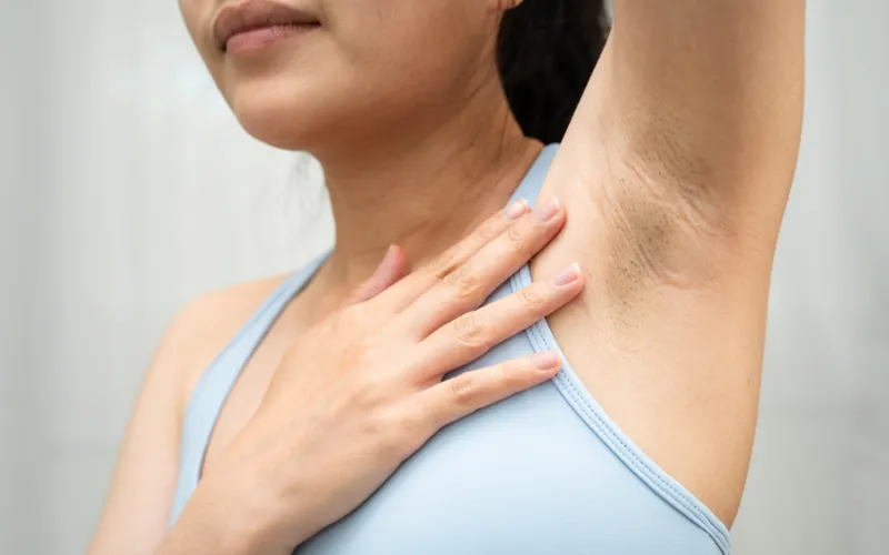 Phản ứng viêm và tăng sắc tố sau viêm (PIH)