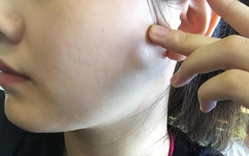 Bề mặt da mỏng, dễ thấy mao mạch