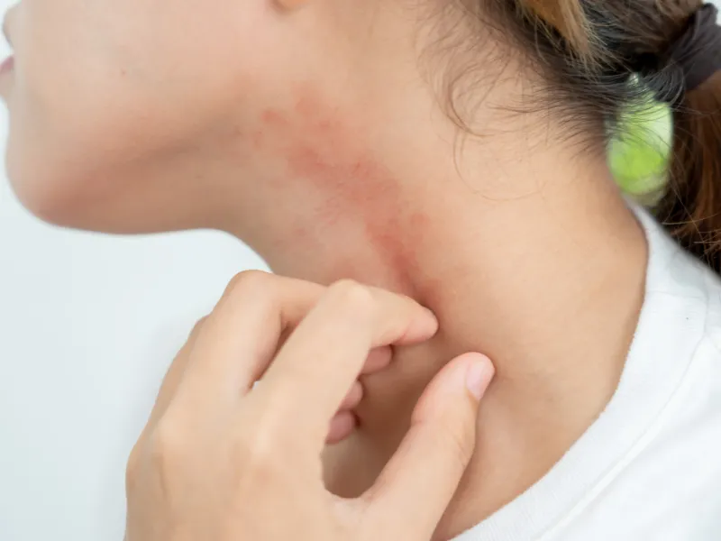 Da dễ nổi mẩn