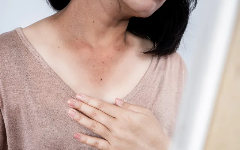 Nám mảng do nắng