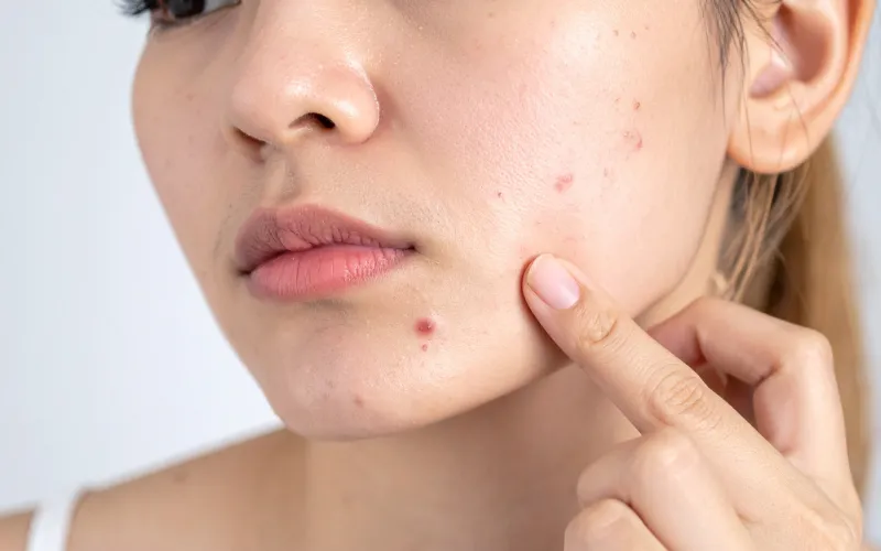 Hiểu về các loại thâm mụn thường gặp trên da