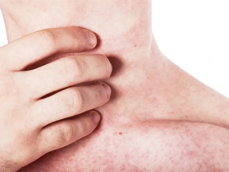 Rôm sảy gây ngứa, châm chích, nóng rát nhẹ hoặc bứt rứt khó chịu.
