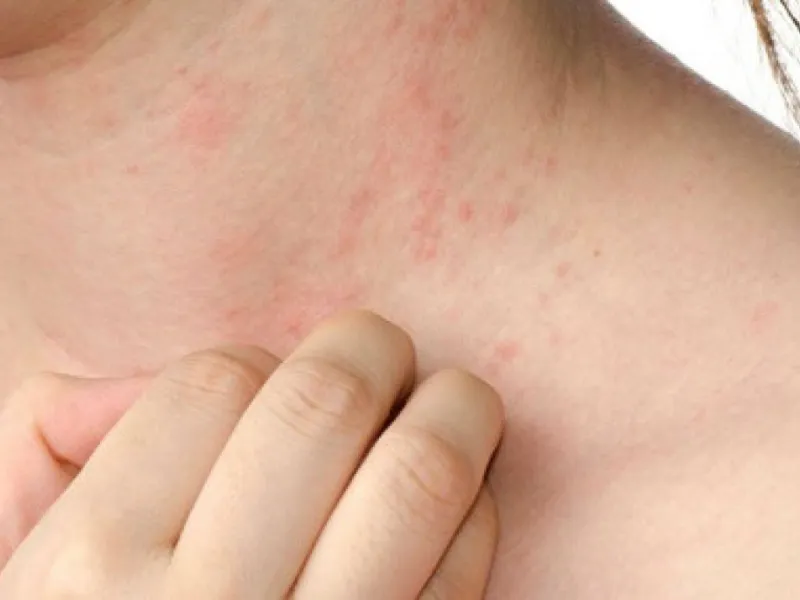 Rôm sảy có nhiều dạng khác nhau