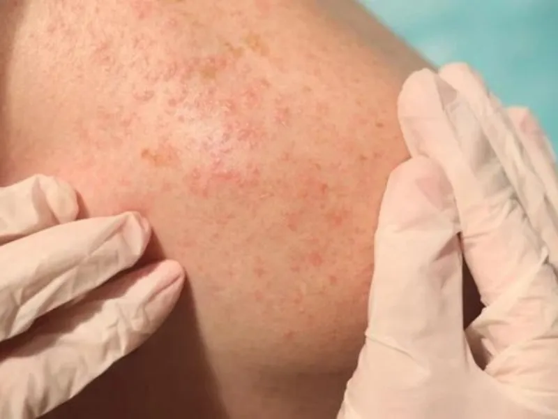 Rôm sảy gây ngứa chủ yếu do mồ hôi bị kẹt lại dưới da kích thích phản ứng viêm.