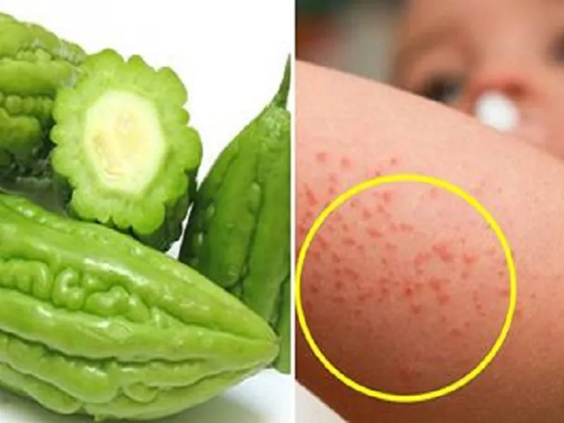 Giảm ngứa rôm sảy bằng cách sử dụng phương pháp dân gian