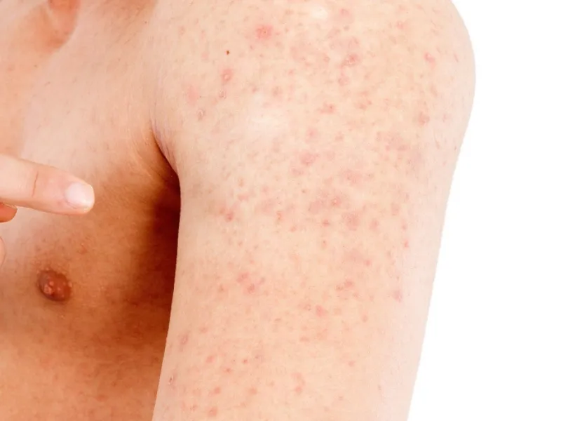 Người lớn bị rôm sảy do nhiều lý do gây ra