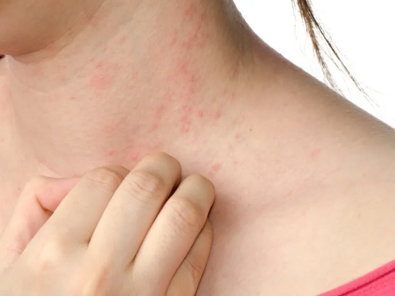 Rôm sảy là tình trạng viêm da xảy ra khi ống dẫ mồ hôi bị tắc nghẽn, khiến mồ hôi ứ đọng dưới da.