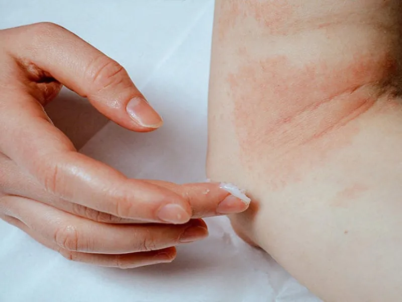 Sử dụng kem bôi giảm ngứa có thể giúp giảm thiểu tình trạng bệnh rôm sảy