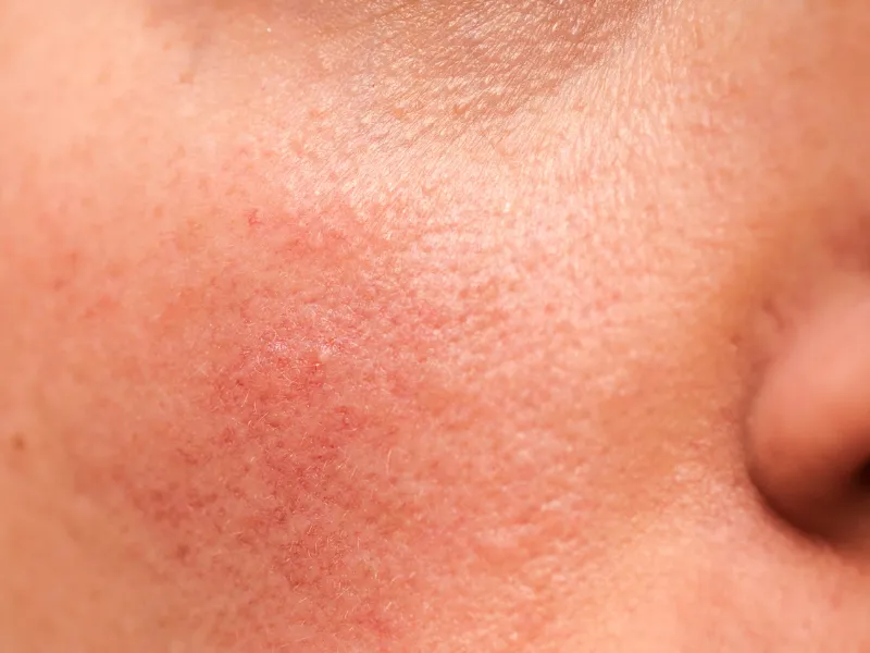Hỗ trợ giảm đỏ nhẹ trong thời gian ngắn